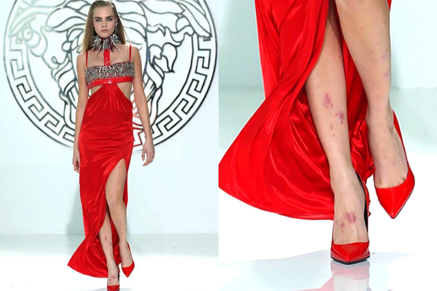 Cara Delevingne 皮膚敏感